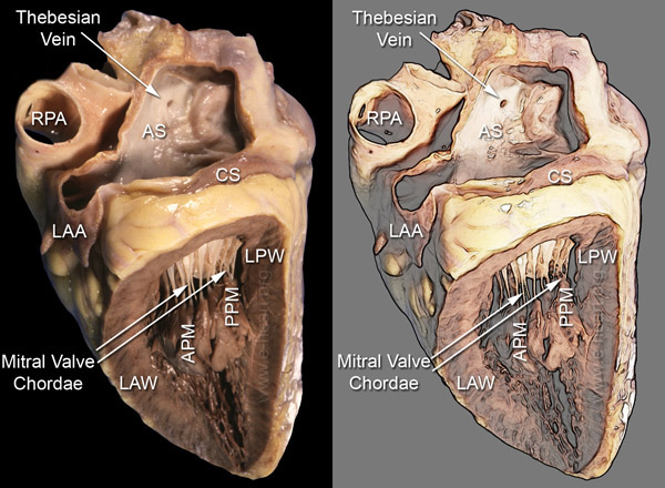 Left Ventricle Laterl View